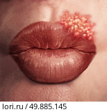 Cold sore herpes virus medical health concept as human lips with an outbreak of swollen fever blisters as an infection on skin. Стоковое фото, агентство Ingram Publishing / Фотобанк Лори