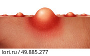 Acne skin health care concept as a group of pimples or sores on human skin as a medical anatomy symbol for a skincare epidermis disorder on a white background. Стоковое фото, агентство Ingram Publishing / Фотобанк Лори