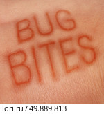 Bug bites medical concept and health care symbol for insect bite infection or skin irritation as human epidermis with text shaped with sores as for lym disease or dengue fever or zika virus and malaria. Стоковое фото, агентство Ingram Publishing / Фотобанк Лори