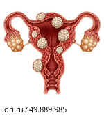 Uterine fibroid medical concept as a human female reproduction uterus disease symbol for fertility problems and reproductive system health. Стоковое фото, агентство Ingram Publishing / Фотобанк Лори