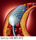 Angioplasty and stent concept as a heart disease treatment symbol with an implant in an artery that has cholesterol plaque blockage being opened for increased blood flow as a 3D illustration. Стоковое фото, агентство Ingram Publishing / Фотобанк Лори