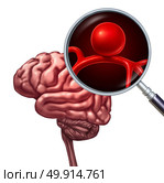 Brain aneurysm or cerebral aneurysms medical disorder concept as a magnification of a human thinking organ with a blood vessel with an inflammation symbol as a risk of rupture as a 3D illustration. Стоковое фото, агентство Ingram Publishing / Фотобанк Лори