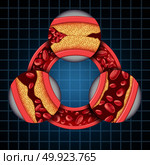 Artery disease symptoms diagram coronary medical concept as a circular vein with gradual plaque formation resulting in clogged arteries and atherosclerosis with with a three dimensional human anatomy diagram showing the risks of cholesterol buildup. Стоковое фото, агентство Ingram Publishing / Фотобанк Лори