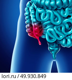 Appendix pain and appendicitis inflammation disease concept as a close up of human intestine anatomy as a 3D illustration. Стоковое фото, агентство Ingram Publishing / Фотобанк Лори