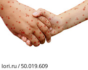 Measles disease concept and viral illness as a contagious chickenpox or a skin rash. Стоковое фото, агентство Ingram Publishing / Фотобанк Лори