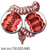 Crohn syndrome disease or crohns illness and healthy colon as a medical concept with a close up of a human intestine with inflammation symptoms causing obstruction as a 3D illustration. Стоковое фото, агентство Ingram Publishing / Фотобанк Лори