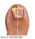 Fungal nail infection and onychomycosisor tinea unguium as an infected foot toenail or toe nail with damaged unhealthy and healthy human anatomy in a 3D illustration style. Стоковое фото, агентство Ingram Publishing / Фотобанк Лори