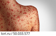 Measles concept as a deadly outbreak immunize,disease and viral illness as a contagious chickenpox or a skin rash in a 3D illustration style. Стоковое фото, агентство Ingram Publishing / Фотобанк Лори