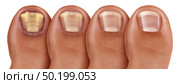 Fungal nail infection recovery diagram and onychomycosisor tinea unguium treatment as an infected foot toenail or toe nail with damaged unhealthy and healthy human anatomy in a 3D illustration style. Стоковое фото, агентство Ingram Publishing / Фотобанк Лори