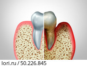 Gum disease comparison with a healthy tooth and an unhealthy one with periodontitis and poor oral hygiene health problem as a bacteria infection diagram concept with inflammation as a 3D illustration. Стоковое фото, агентство Ingram Publishing / Фотобанк Лори