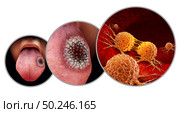 Tongue cancer medical concept or squamous cell carcinoma as malignant tumor disease in the mouth with 3D illustration elements. Стоковое фото, агентство Ingram Publishing / Фотобанк Лори