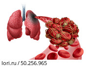 Pulmonary Embolism with a blood clot as a disease with a blockage of an artery in the lungs with 3D illustration elements. Стоковое фото, агентство Ingram Publishing / Фотобанк Лори