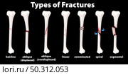 Type of Fractures diagram. Стоковая иллюстрация, агентство Ingram Publishing / Фотобанк Лори