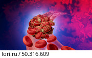 Blood clot health risk or thrombosis medical illustration concept symbol as a group of human blood cells clumped together by sticky platelets and fibrin as a blockage in an artery or vein as a 3D render. Стоковое фото, агентство Ingram Publishing / Фотобанк Лори