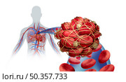 Pulmonary Embolism illness with a blood clot as a disease with a blockage of an artery in the lungs with 3D illustration elements. Стоковое фото, агентство Ingram Publishing / Фотобанк Лори