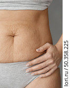 close up body with stretch marks. Стоковое фото, агентство Ingram Publishing / Фотобанк Лори