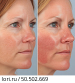 Changes in skin tone during a dermatological treatment session on a patient’s face. Стоковое AI-изображение, AI-художник Татьяна  Бральнина / Фотобанк Лори
