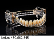 Removable partial denture showing metal framework and plastic base holding artificial teeth. Стоковое AI-изображение, AI-художник Иван Рябоконь / Фотобанк Лори
