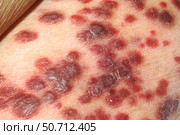 Kaposi's sarcoma on the skin of an AIDS patient. Стоковое фото, фотограф National Institutes of Health /Stocktrek/Stocktrek Images / ТАСС / Фотобанк Лори