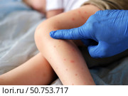 Doctor examining child with bodily red rash. Kid allergy closeup. Little baby scratches an eruption. Nurse applies special cream to atopic skin. Dermatitis, irritation, hive. Pruritus. Mosquito bites. Стоковое фото, фотограф Марина Демидюк / Фотобанк Лори