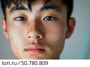 Young man showing freckles and acne scars on face. Стоковое AI-изображение, AI-художник Иван Рябоконь / Фотобанк Лори