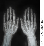 X-ray of the hands for examination by a doctor. Bone fractures. The concept of medicine and science. Стоковое фото, фотограф Наталия Кирсанова / Фотобанк Лори
