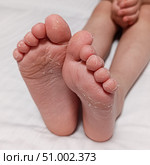 Dry feet peeling skin on feet. Air allergy, chemical allergy. Dermatitis. Eczema. Dyshidrosis. Baby feet. White background. Стоковое фото, фотограф Екатерина Топорова / Фотобанк Лори