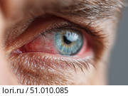 Human Eye with Conjunctivitis extreme close up. Closeup irritated infected red bloodshot eye. Male Eye. Vision. Eyesight. Adult Pain Eye Opening Wide. Viral infection with redness of eyeball. Macro. Стоковое AI-изображение, AI-художник Марина Демидюк / Фотобанк Лори