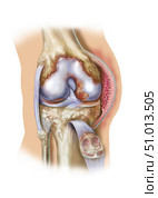 Front view of knee joint opened to show pannus. Стоковое фото, фотограф Elise Walmsley-MacWha/Stocktrek Images / ТАСС / Фотобанк Лори
