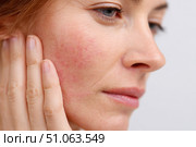Sensitive skin. Woman scratches cheek with red rash, allergy symptom. Skin irritation, dermatitis, itchy skin problem. Face affected with Allergic reaction. Person suffering from itching, scratching. Стоковое AI-изображение, AI-художник Марина Демидюк / Фотобанк Лори