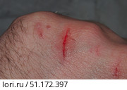 A bleeding scratch on the back of his hand. Small injury. Стоковое фото, фотограф Олег Тараканов / Фотобанк Лори