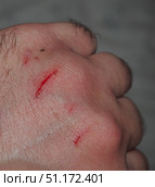 A bleeding scratch on the back of his hand. Small injury. Стоковое фото, фотограф Олег Тараканов / Фотобанк Лори