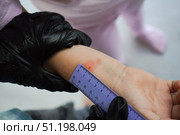 Up-close photograph of a child's hand displaying a red swelling from the Mantoux procedure. Стоковое фото, фотограф Ирина Старикова / Фотобанк Лори