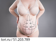 Diastasis recti, diastase of the rectus abdominis muscles, recovery after pregnancy, abdomen liposuction, fat and cellulite removal concept. Стоковое фото, фотограф Станислав Тарко / Фотобанк Лори
