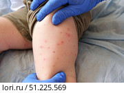 Doctor examining child with bodily red rash. Kid allergy closeup. Little baby scratches an eruption. Nurse applies special cream to atopic skin. Dermatitis, irritation, hive. Pruritus. Mosquito bites. Стоковое фото, фотограф Марина Демидюк / Фотобанк Лори