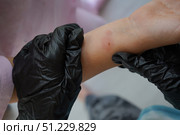Close-up image of a young child's hand with a reaction spot from the Mantoux skin test. Стоковое фото, фотограф Ирина Старикова / Фотобанк Лори