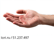 Human Hands with Painful Rash, Red Spots Blisters on the Skin. Health Problem. Monkeypox Disease Symptoms. Male Patient Arms with Monkey Pox. Close Up. Dengue Fever Infection, MPOX. Herpes, Pox Virus. Стоковое AI-изображение, AI-художник Марина Демидюк / Фотобанк Лори
