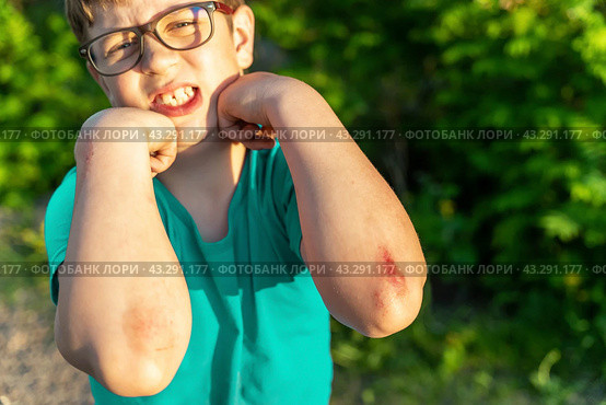 A young boy with a broken elbow, showing a bloody wound on his arm. Стоковое фото, фотограф Андрей Знаменский / Фотобанк Лори