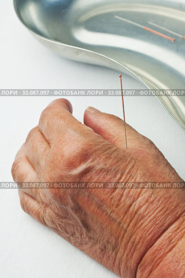 Acupuncture treatment. Стоковое фото, фотограф Hans-Joachim Schneider / PantherMedia / Фотобанк Лори