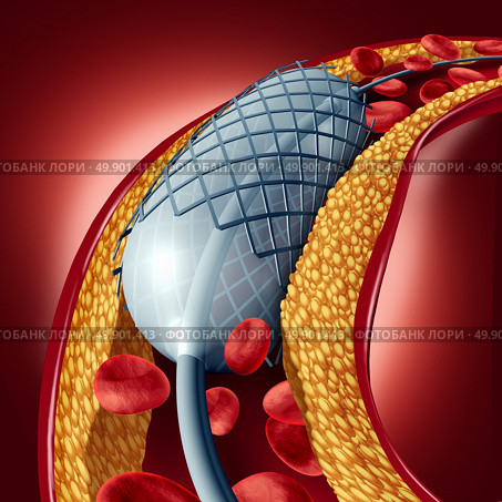 Angioplasty and stent concept as a heart disease treatment symbol with an implant in an artery that has cholesterol plaque blockage being opened for increased blood flow as a 3D illustration. Стоковое фото, агентство Ingram Publishing / Фотобанк Лори