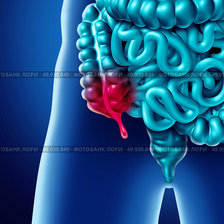 Appendix pain and appendicitis inflammation disease concept as a close up of human intestine anatomy as a 3D illustration. Стоковое фото, агентство Ingram Publishing / Фотобанк Лори