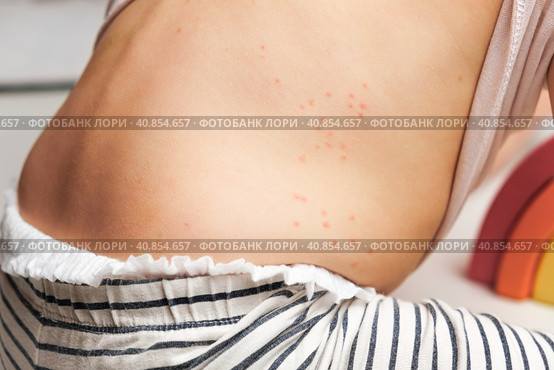 Back of Small Child with Red Rash. Baby with Red Spots Blisters on the skin. Close up of Painful Rash. Health Problem. Rubella, Chickenpox, Scarlet fever, Measles. Bacterial Infections, Disease. Стоковое фото, фотограф Марина Демидюк / Фотобанк Лори