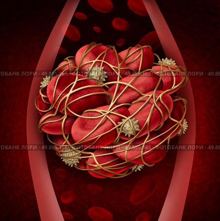 Blood clot and thrombosis medical illustration concept as a group of human blood cells clumped together by sticky platelets and fibrin creating a blockage in an artery or vein as a health disorder symbol for circulatory system danger. Стоковое фото, агентство Ingram Publishing / Фотобанк Лори