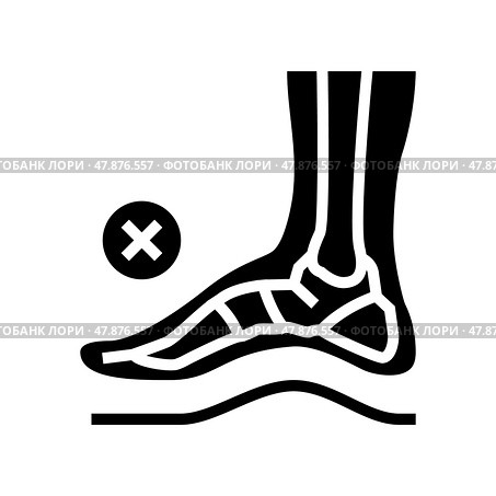 bone postural deformity feet glyph icon vector illustration. Стоковая иллюстрация, иллюстратор Vectorwin / Фотобанк Лори