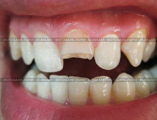 Broken tooth. Broken upper incisor in a man mouth. Стоковое фото, фотограф Леонид Еремейчук / Фотобанк Лори