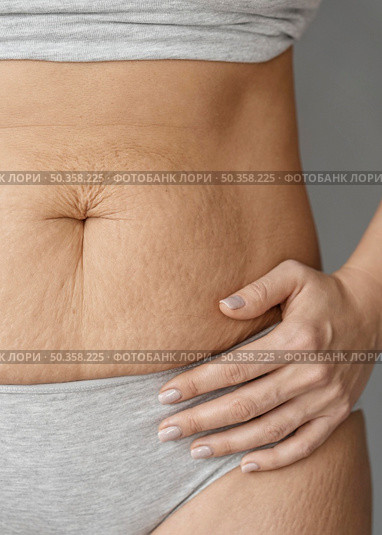 close up body with stretch marks. Стоковое фото, агентство Ingram Publishing / Фотобанк Лори