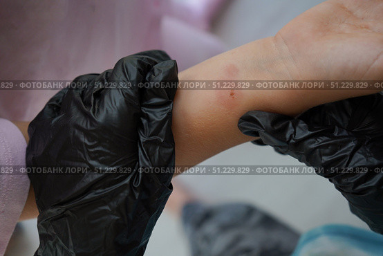Close-up image of a young child's hand with a reaction spot from the Mantoux skin test. Стоковое фото, фотограф Ирина Старикова / Фотобанк Лори