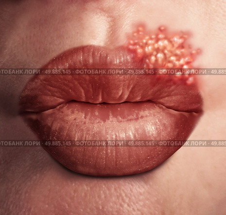 Cold sore herpes virus medical health concept as human lips with an outbreak of swollen fever blisters as an infection on skin. Стоковое фото, агентство Ingram Publishing / Фотобанк Лори