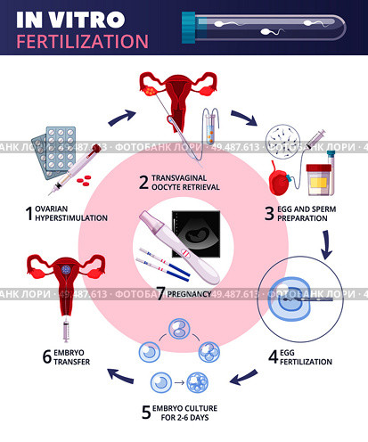 Colored flat in vitro fertilization IVF  infographics with steps from ovarian huperstimulation to pregnancy vector illustration. Стоковая иллюстрация, агентство Ingram Publishing / Фотобанк Лори