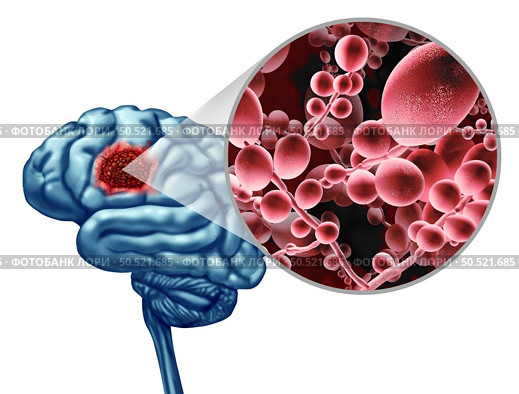 Deadly Brain Fungal Infection concept as a microbe threat and mucormycosis life threatening fungus as Candida auris fungi spreading in the nervous system as a 3D illustration. Стоковое фото, агентство Ingram Publishing / Фотобанк Лори